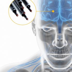 Sistema ISIS MER: Microregistro Cerebral